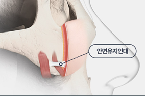 윤곽수술(광대축소수술, 사각턱수술) 후 볼처짐, 살처짐은 걱정해야 하는 부분일까? 관련 이미지 3
