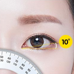 Dual Canthoplasty: Performing Outer and Lower Canthoplasty at the Same Time image 6