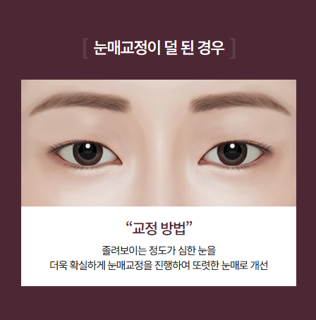 눈재수술 시 눈매교정이 꼭 필요할까? 관련 이미지 5