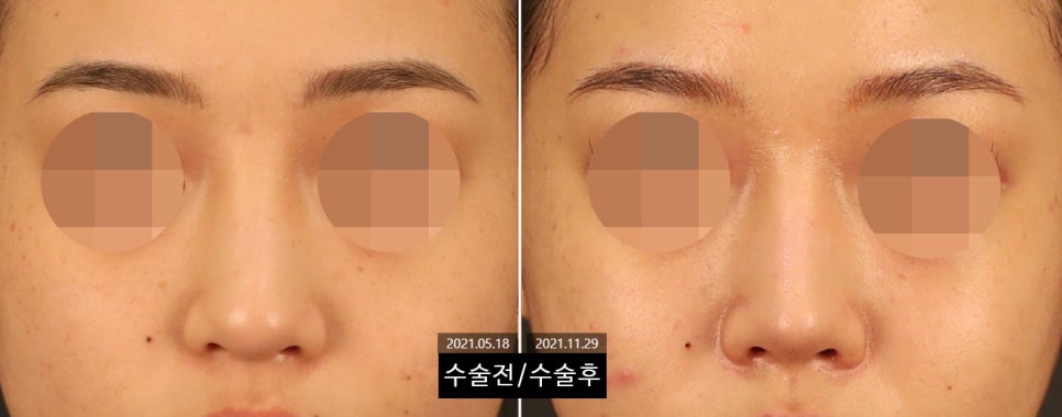 How Can Wide Nostrils Be Corrected? (Effective Bulbous Nose Correction Methods) image 8