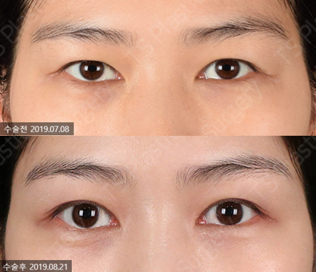 20~30대 이마리프팅 왜 필요할까? 관련 이미지 6