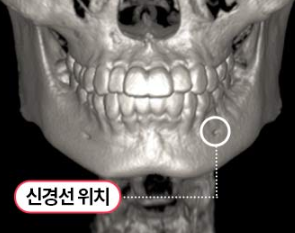 Facial Contouring Surgery for Improving Face Shape: Preparation for the Right Choice image 4