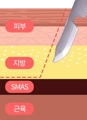 미니거상술 스마스층 고정이 중요한 이유 관련 이미지 2