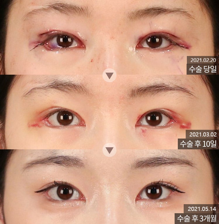 Revision Eyelid Surgery Case: Correcting an Eye Shape That Felt Heavy and Constricted Due to High, Thick Double Eyelids image 2