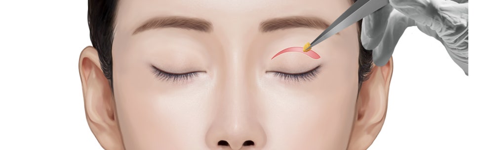 눈성형, 쌍꺼풀 수술 같은 라인도 다르게 보이는 이유는? 관련 이미지 2