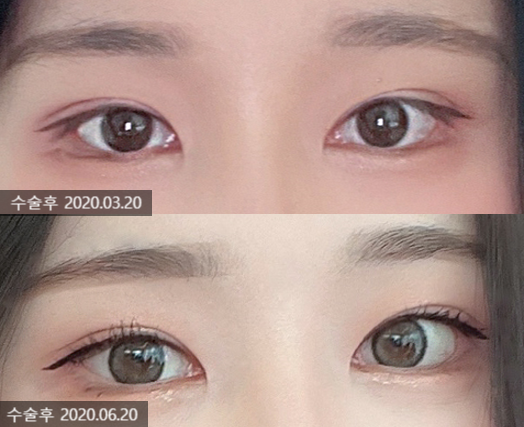 Revision Eyelid Surgery Case: Correcting an Eye Shape That Felt Heavy and Constricted Due to High, Thick Double Eyelids image 3