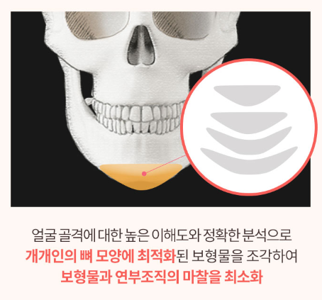 It Is Important to Perform Chin Augmentation with a Chin Implant by Considering Individual Facial Proportions image 6