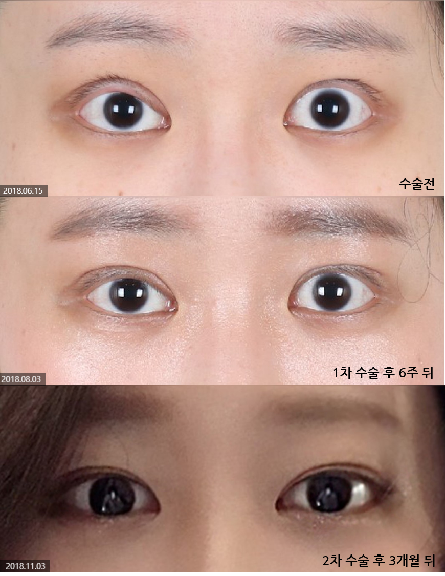 Revision Eyelid Surgery Review (3) Extreme Eyes, Cases of Improvement After Overcorrection in Eyelid Correction image 5