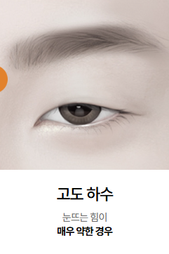 눈재수술 시 눈매교정이 꼭 필요할까? 관련 이미지 3