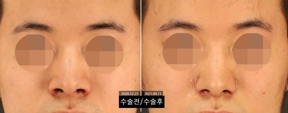 How Can Wide Nostrils Be Corrected? (Effective Bulbous Nose Correction Methods) image 2