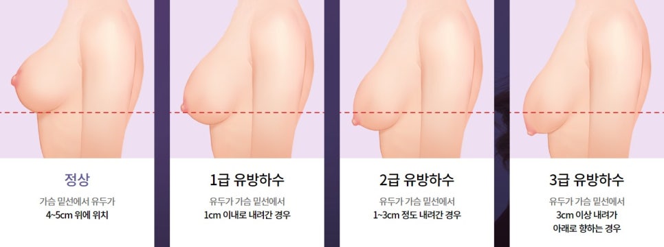 In Which Cases Can Sagging Breasts Be Improved with Implants Alone? image 2
