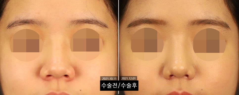 How Can Wide Nostrils Be Corrected? (Effective Bulbous Nose Correction Methods) image 3