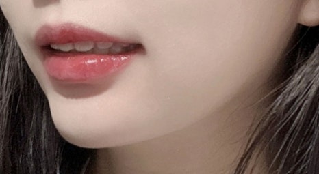 It Is Important to Perform Chin Augmentation with a Chin Implant by Considering Individual Facial Proportions image 4