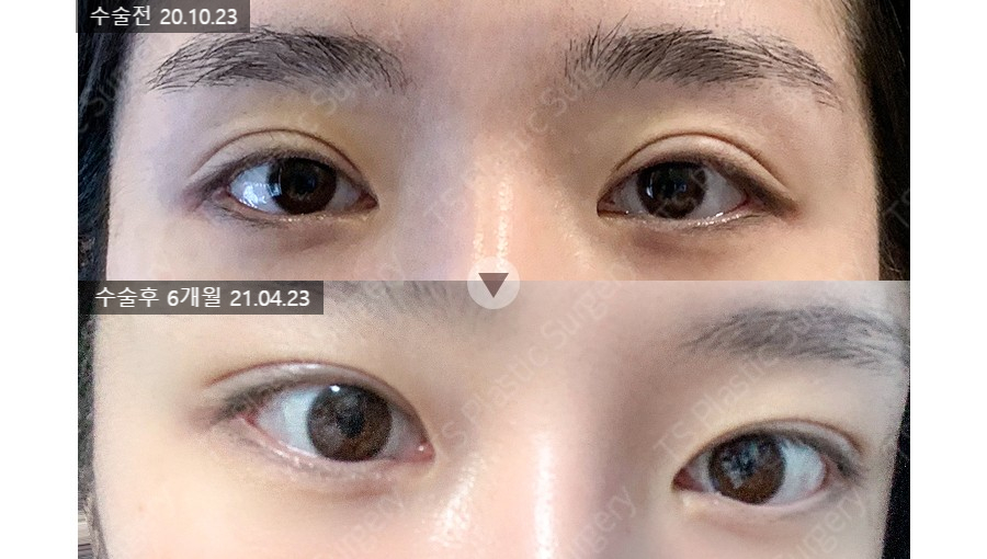 크고 시원한 눈매, 반드시 세미아웃라인이나 아웃라인이어야 할까요? 관련 이미지 3