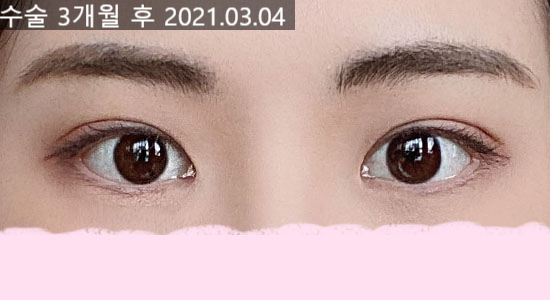자연스러운 쌍꺼풀 라인 개선을 위한 방법 관련 이미지 4