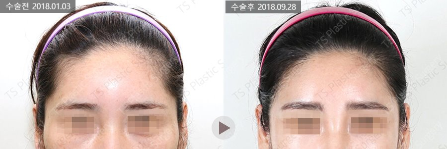 안면윤곽수술 후 헤어라인 교정과 모발이식이 필요한 이유는? 관련 이미지 5