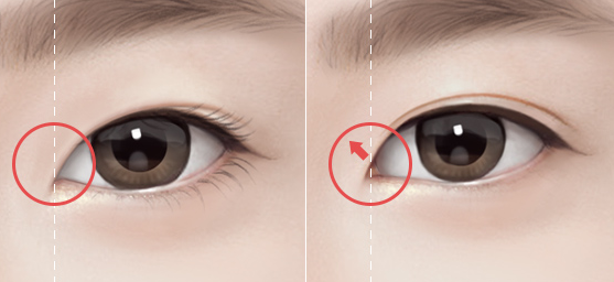 Rhinoplasty? No, Eye Surgery: The Right Approach for a Natural Result image 3