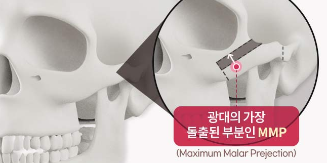 자연스러운 앞광대, 옆광대를 위한 광대축소 수술과 부작용 예방 방법 관련 이미지 2