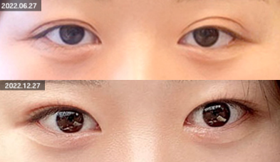 눈매교정으로 보다 선명한 눈매 만들기, 고려할 점은? 관련 이미지 2