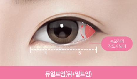 Dual Canthoplasty: Performing Outer and Lower Canthoplasty at the Same Time image 4
