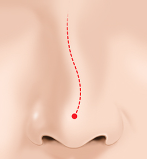 Considerations for Satisfying Results After Rhinoplasty image 2
