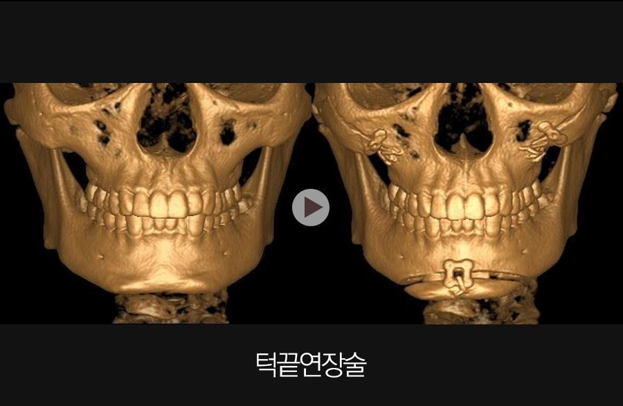 턱끝수술, 짧은 턱과 세로 길이 고민에 도움 될 수 있을까? 관련 이미지 5
