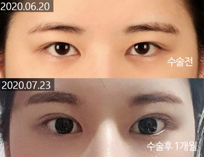 Changes and Causes That Can Occur When the Double Eyelid Line Becomes Weaker image 9