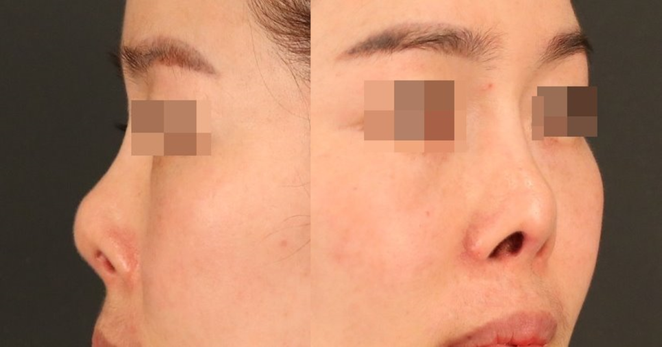 What Is Contracted Nose? Causes That Can Lead to Revision Rhinoplasty and Key Management Points image 1