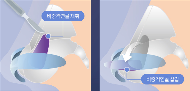 Natural Rhinoplasty That Refines the Nasal Tip with Ear Cartilage image 2