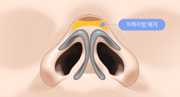 If hump nose surgery and alar reduction are performed together, it may help achieve harmonious facial proportions image 2