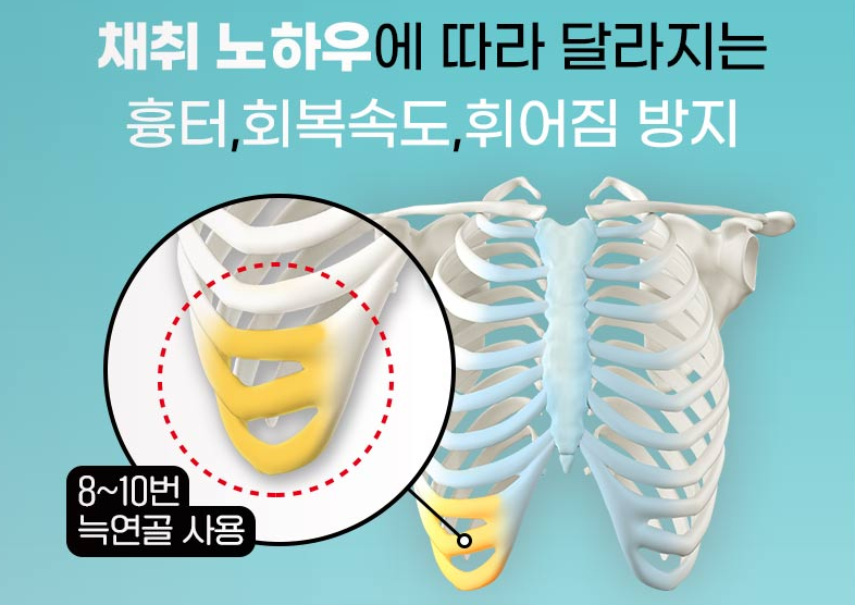 코재성형 자가늑 연골의 장점 관련 이미지 3