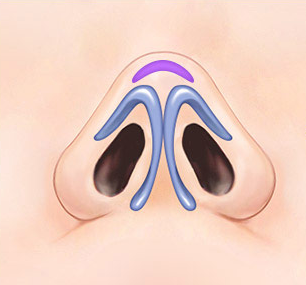 Natural Rhinoplasty That Refines the Nasal Tip with Ear Cartilage image 3