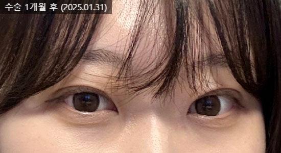 If You’re Worried About a Sausage-Like Double Eyelid, Check Whether the Hospital Is Good at Double-Line Method Revision Surgery image 3