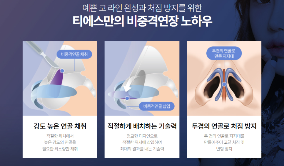 짧은코,들창코 이 경우 비중격 연장술이 꼭 필요할까? 관련 이미지 6
