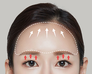Explore Various Ways to Improve a Drooping Forehead image 2
