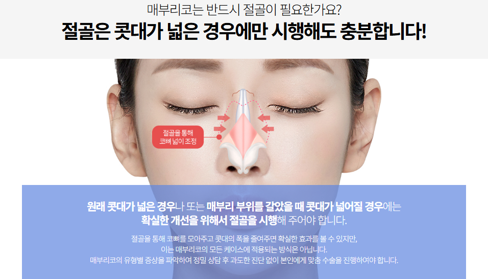 매부리코성형, 매부리 유형에 따라 수술 방향이 달라진다면? 관련 이미지 4