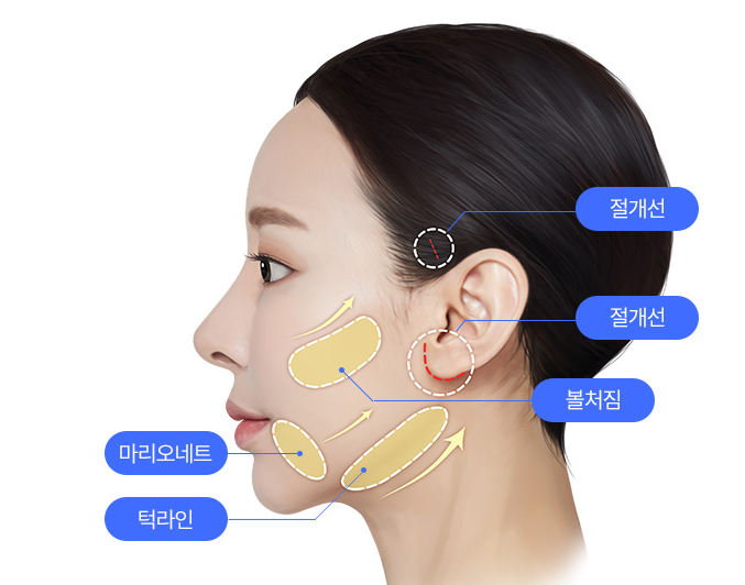 안면거상술이 필요한 경우는? 얼굴거상술이 도움이 될 수 있는 경우를 알아보세요! 관련 이미지 1