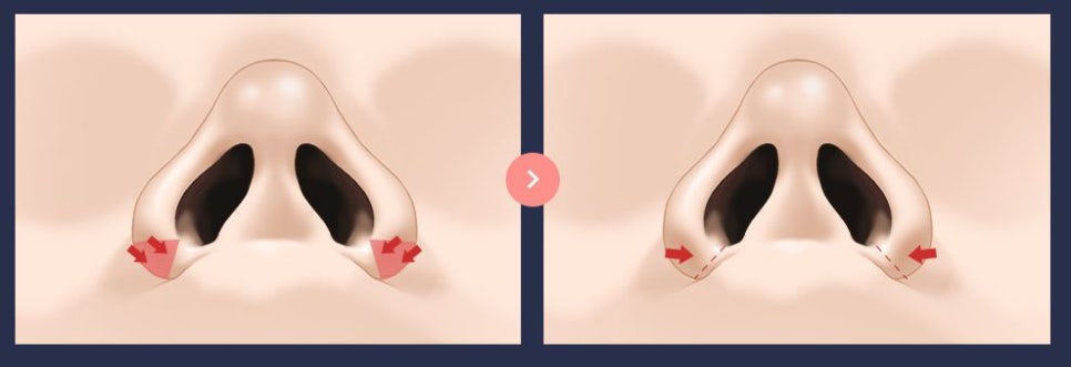 How Can Wide Nostrils Be Corrected? (Effective Bulbous Nose Correction Methods) image 1