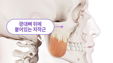 윤곽수술(광대축소수술, 사각턱수술) 후 볼처짐, 살처짐은 걱정해야 하는 부분일까? 관련 이미지 4