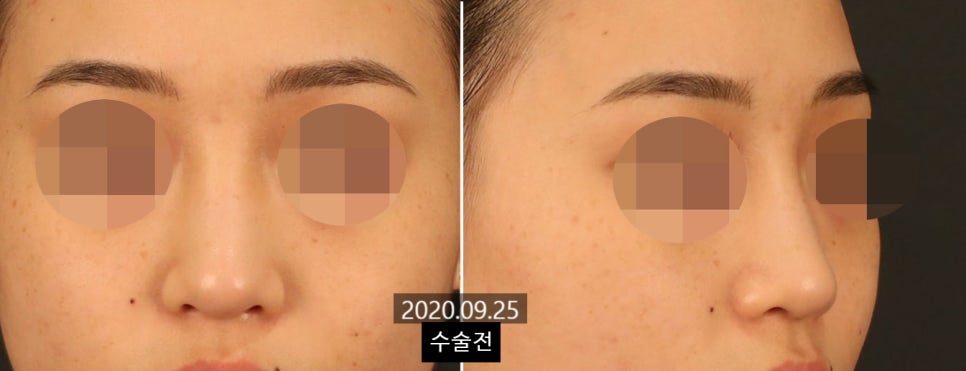 코수술 후 변화가 뚜렷하게 느껴지는 얼굴 유형 4가지 관련 이미지 1