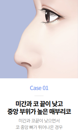 매부리코성형, 매부리 유형에 따라 수술 방향이 달라진다면? 관련 이미지 1