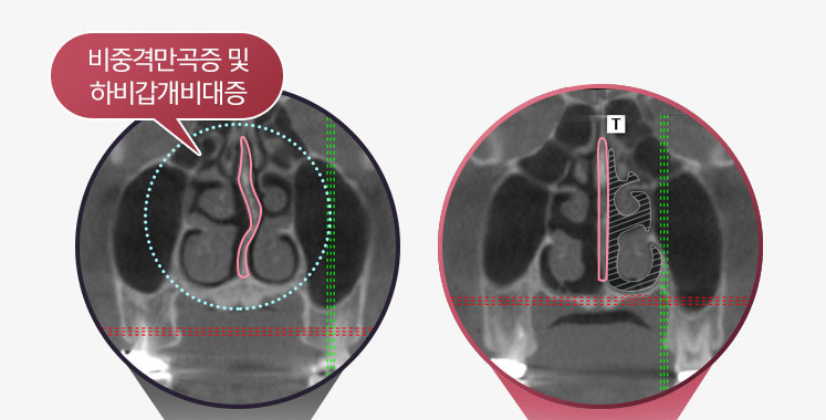 The Key Is Naturalness! Rhinoplasty Completed with Autologous Tissue image 2