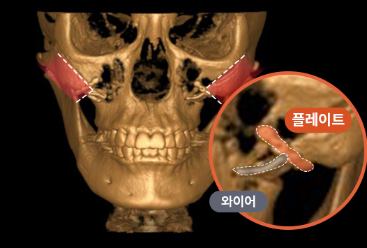 광대축소수술에 효과적인 케이스와 수술 시 고정이 중요한 이유 관련 이미지 6