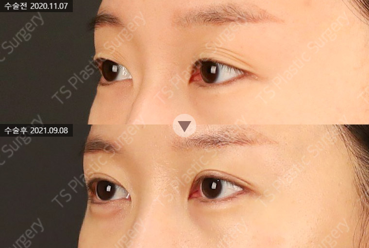꺼진 눈과 겹주름, 눈두덩이 지방이식 시 주의할 점은? 관련 이미지 5