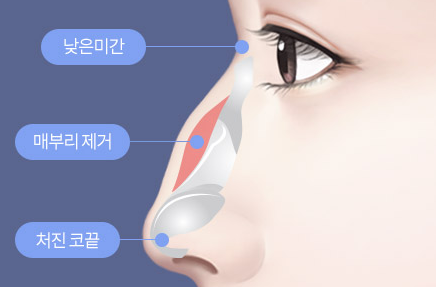Things to Consider When Thinking About Revision Surgery for a Hump Nose image 4