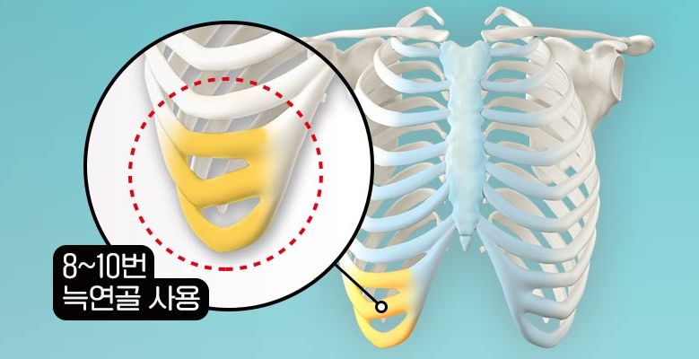 자가늑 코수술의 장점과 주의사항 관련 이미지 3