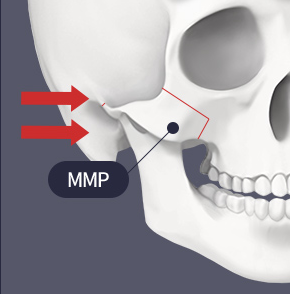 Differences in Preferred Contour Lines for Facial Contouring Surgery in Men and Women image 1