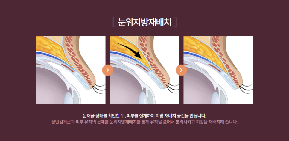 눈두덩이 꺼짐 겹주름눈 지방이식이 아닌 눈위지방재배치로 충분할까? 관련 이미지 2