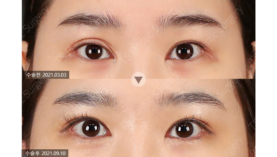 Can the Line Be Changed Because of an Epicanthoplasty Scar? How to Change It to an Outlined, Inline, or In-Out Line image 2