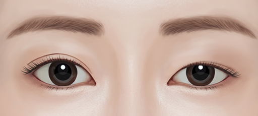 Important Points to Consider When Thinking About Revision Surgery After Eye Surgery image 3